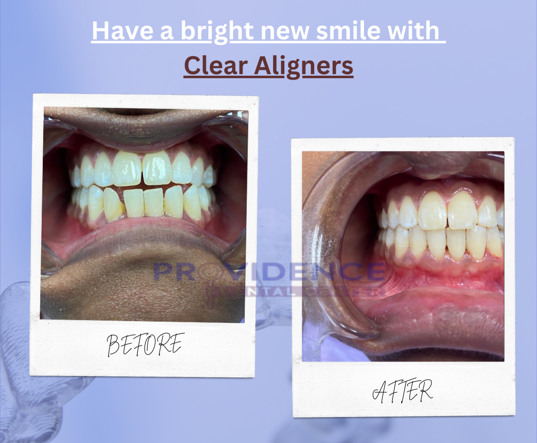 Aligners Before and After Aligners Before and After
