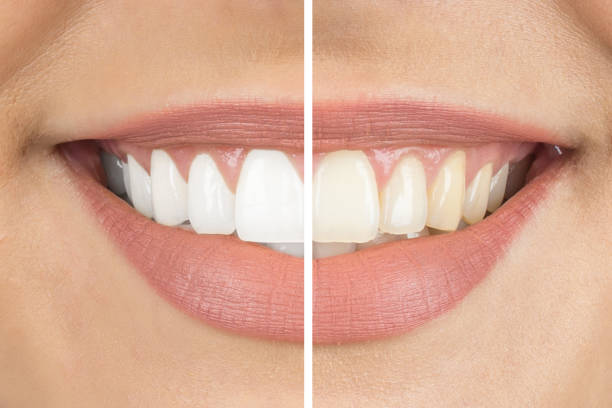 Before and after Before and after