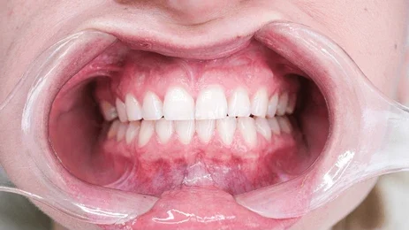 teethwhiteningstock-6 teethwhiteningstock-6